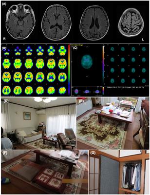 Case report: Environmental adjustment for visual hallucinations in dementia with Lewy bodies based on photo assessment of the living environment